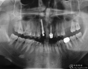 国产种植体视频
